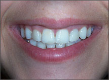 After-Braces-Implants-Crowns-Atlanta-GA