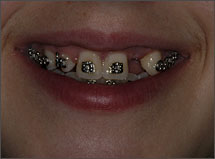 Before-Braces-Implants-Crowns-Atlanta-GA