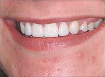 Porcelain-Veneers-Atlanta-GA