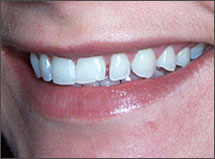 Veneers-Atlanta-GA