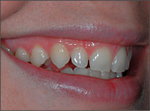 Porcelain-Veneers-Atlanta-GA