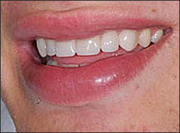 After-Veneers-Atlanta-GA
