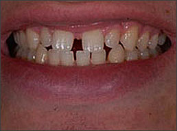 Before-Veneers-Atlanta-GA