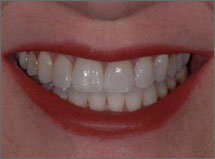 After-Veneers-Atlanta-GA