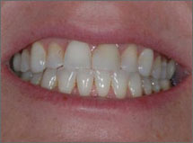 Before-Veneers-Atlanta-GA