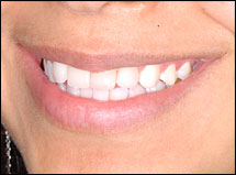 Veneers-Atlanta-GA
