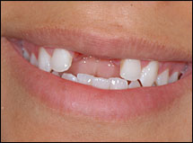 Porcelain-Veneers-Atlanta-GA