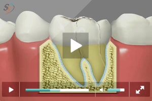 Crack Tooth Syndrome