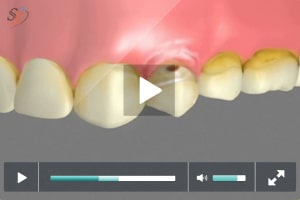 Fracaso en el tratamiento de la abrasi?n dental