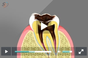 Progresi?n de la caries dental