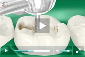 Videos educativos en 3D de pacientes dentales en 3D para todos los  tratamientos dentales
