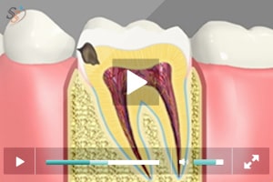 Rellenos de color dental - Clase II