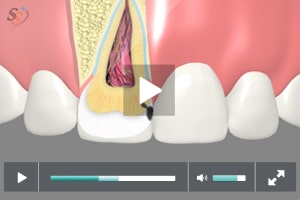 Rellenos de color dental - Clase III