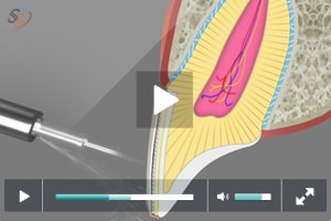 Laser Maxillary Veneers Removing