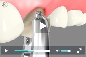 Routine Tooth Extraction