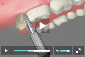 Third Molar Extraction - Erupted Tooth (Maxillary)