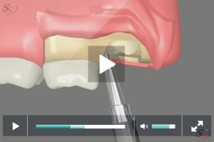 Third Molar Extraction - Maxillary