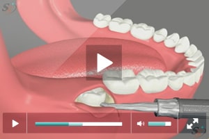 Third Molar Extraction - Vertical