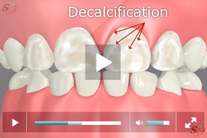 Decalcification On Baby Teeth