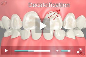 Descalcificaci?n en dientes de leche