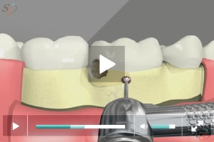 Alargamiento de corona (con herramienta Bur) - Escenario I