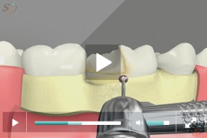 Alargamiento de corona (con herramienta Bur) - Escenario II