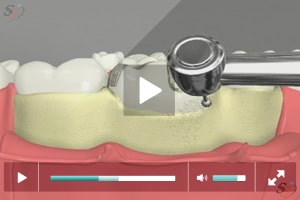 Alargamiento de corona (con herramienta Bur) - Escenario III