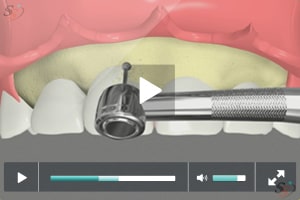 Alargamiento de corona (con herramienta Bur) - Escenario IV