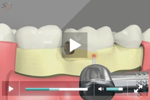 Crown Lengthening(With Laser Tool) - Scenario I