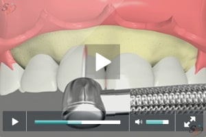 Crown Lengthening(With Laser Tool) - Scenario IV