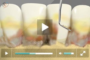 Periodontitis avanzada