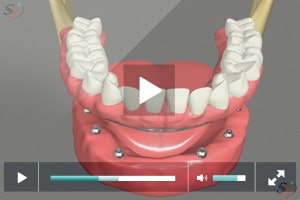 Opci?n de pr?tesis fija de implante - Mandibular