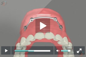 Fixed Implant Denture Option - Maxillary