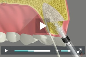 Implant Placement Following Bone Grafting