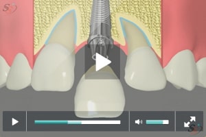 Restauraci?n de implantes - Opci?n 1