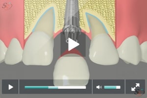 Restauraci?n de implantes - Opci?n 2