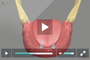 Implante con dentadura postiza - Escenario 1