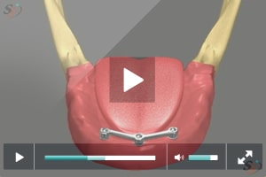 Implante con dentadura postiza - Escenario 2