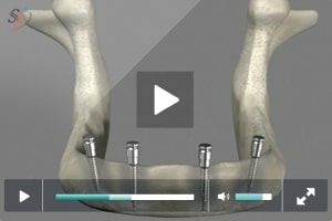 Mini implantes en mandibular