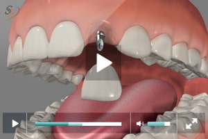 Mini implantes en incisivo lateral maxilar