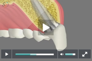 Dental implants patient education video Linden NJ