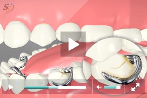 Desventajas de las dentaduras parciales