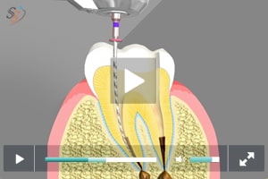 Root Canal Treatment Linden